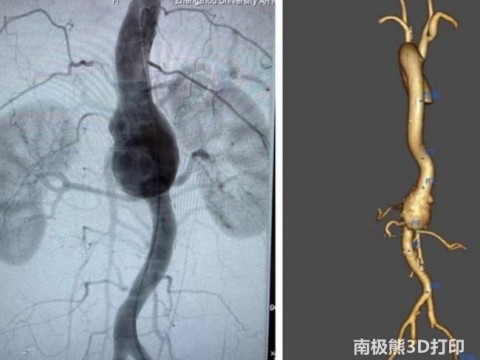 “3D打印”技术助力治疗高难度主动脉瘤