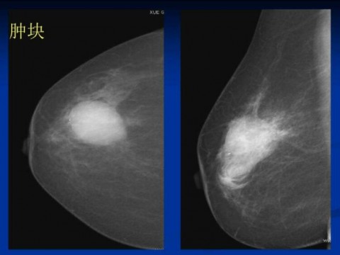 人工智能对乳腺癌诊断比医生更准确